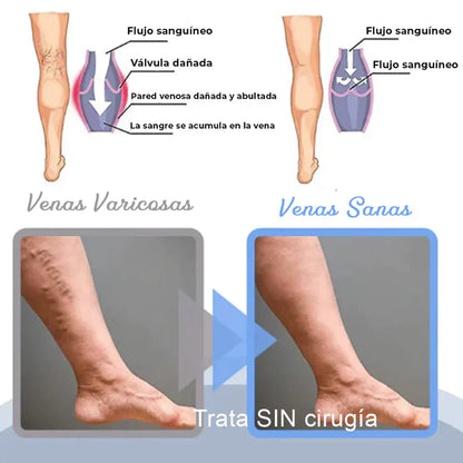 ¡Nuevo! VarixFree® Spray Herbal Plus🌿 - Piernas sin várices en solo 7 días✨